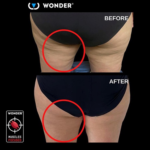 Rezultat Wonder tretmana